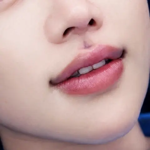 ภาพผลลัพธ์การยกมุมปากที่ซินย่า คลินิก