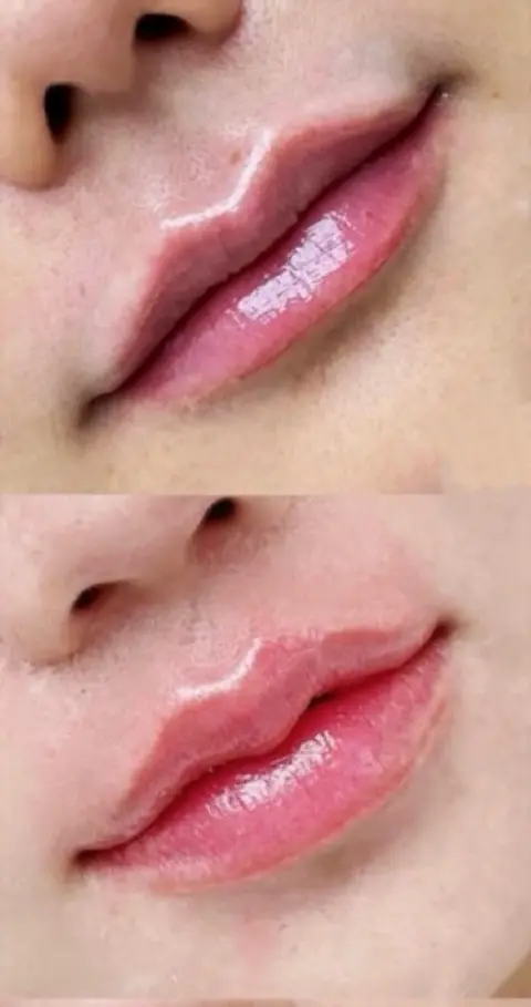 ภาพผลลัพธ์การยกริมฝีปาก