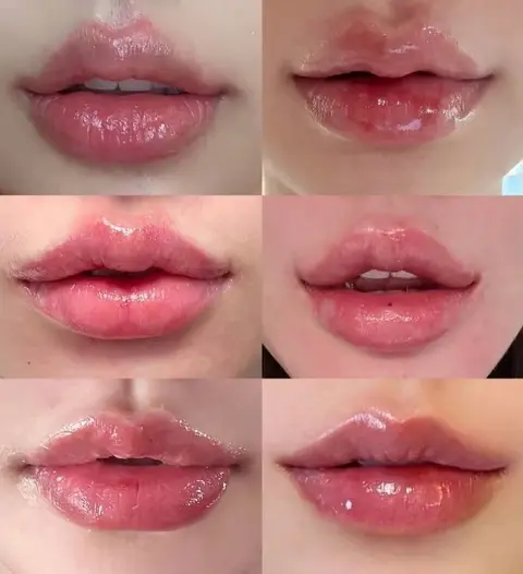ภาพรวมผลลัพธ์การปรับสีริมฝีปากหลายเคส