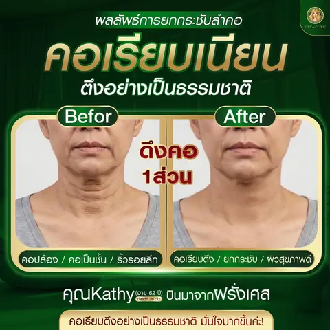 ภาพเปรียบเทียบก่อนและหลังการดึงคอที่ซินย่า คลินิก