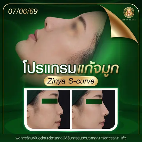 ภาพเปรียบเทียบก่อนและหลังการเสริมจมูกทรง S-curve