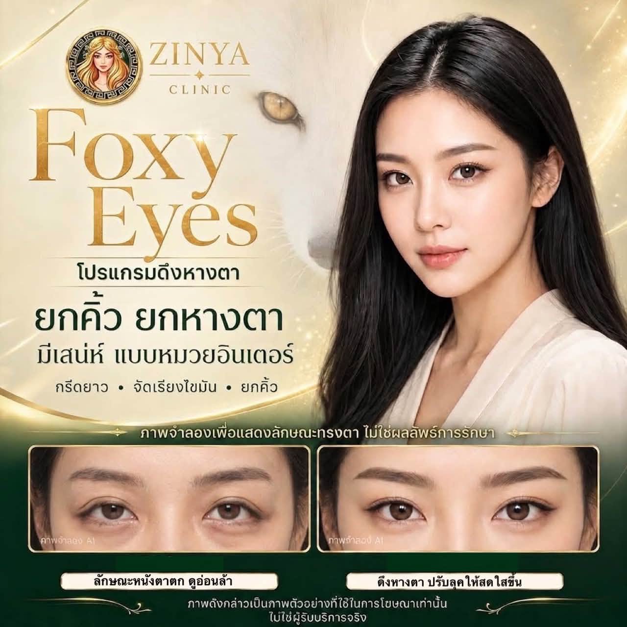 ดึงตา Foxy Eyes ที่ซินย่า คลินิก